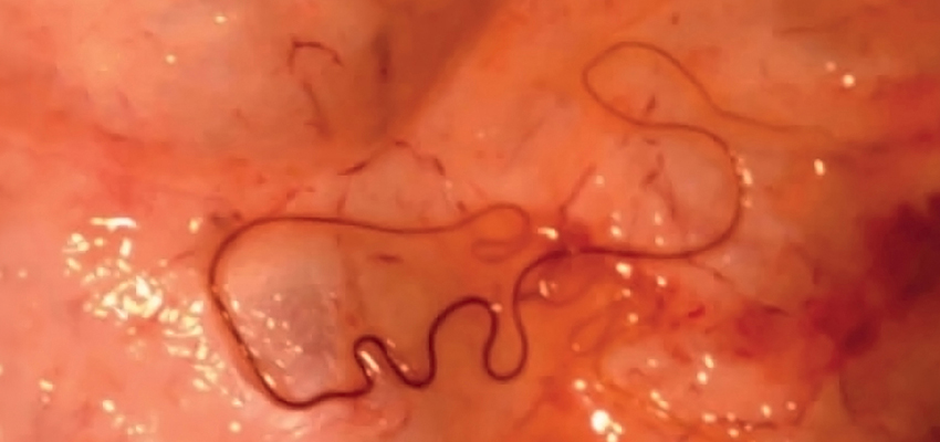 Meningeal Worm